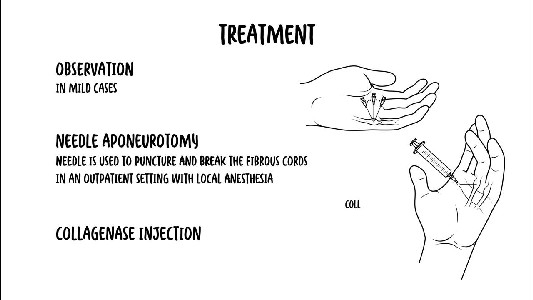 What is Dupuytren's Contracture/ - YouTube